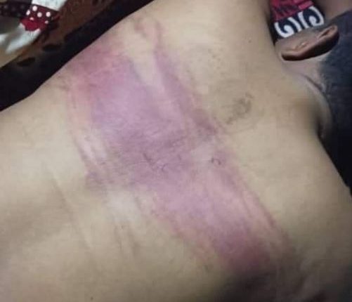 مليشيا الإمارات تختطف مواطن من ابناء الصبيحة وتقوم بتعذيبه بطريقة بشعة وتترك علامات الندوب والتعذيب على جسده 