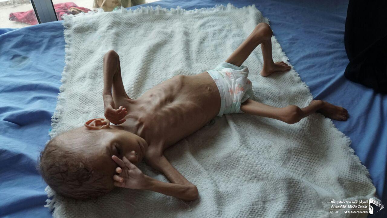 صور مؤلمة لأطفال اليمن ستجعلك تبكي حتما