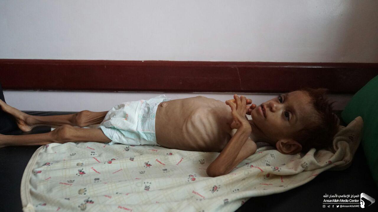 صور مؤلمة لأطفال اليمن ستجعلك تبكي حتما
